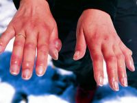 Что делать при обморожении пальцев рук или ног