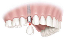 зубном протезировании у детей